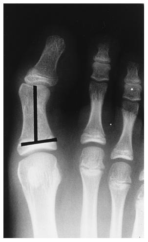 Photograph and radiograph of a foot with hallux valgus