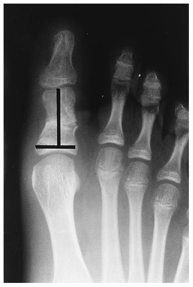 11-A and 11- B, after correction of the hallux valgus