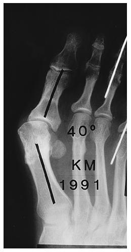 Figs. 13-A and 13-B: Radiographs made after the performance of an Akin procedure (1,8,88,109,126) in a foot with a moderate hallux valgus deformity. Fig.