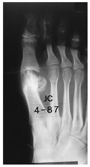 Anteroposterior (Fig. 22-A) and axial (sesamoid) (Fig.