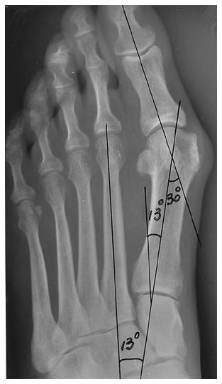 Figs. 24-A and 24-B: Radiographs made before and after a distal