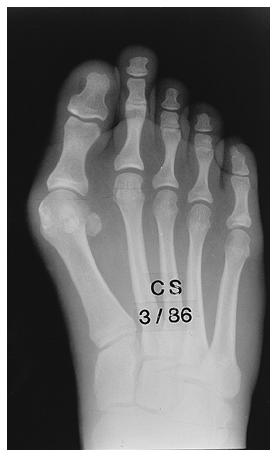 Figs. 27-A and 27-B: Radiographs made before and after a proximal osteotomy of the first metatarsal