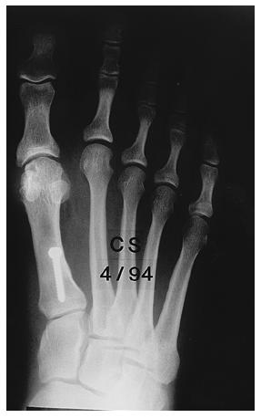 27-A: Preoperatively, the hallux valgus angle is 45 degrees and the first-second intermetatarsal