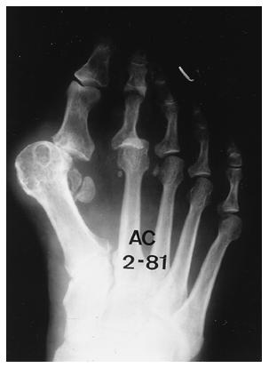 34-A and 34-B: Radiographs made before and after arthrodesis of the first