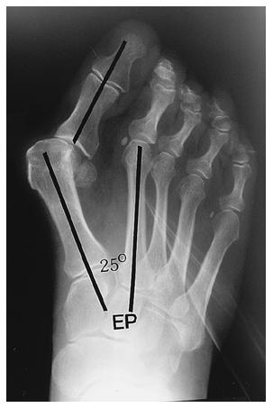 Fig. 34-B: Six months postoperatively, there is a painless fibrous union and the deformity is much less severe. Figs.