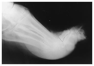 Photograph and radiograph of a cock-up deformity of the great toe after an excisional arthroplasty. Figs.