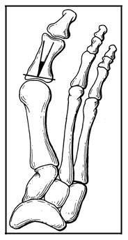 Illustration demonstrating the radiographic measurements in the assessment of hallux valgus.