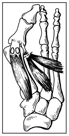 Illustration of a distal soft-tissue reconstruction. The conjoined adductor tendon is released, leaving a 1.