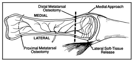 A dorsal view of the first metatarsal.