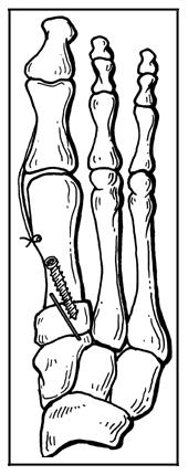 Fig. 23-D: With an increased distal metatarsal articular angle, a trapezoidal resection allows realignment of a congruous metatarsophalangeal joint.