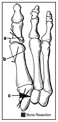 Appearance of a foot after a triple osteotomy.