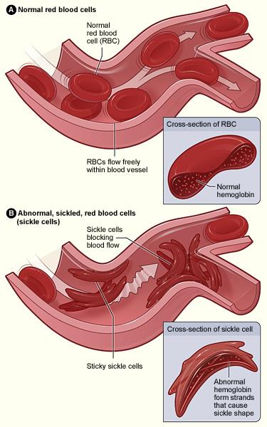 Sickle cell disease Hereditary condition in which the individual has sickle-shaped red blood cells that tends to rupture as they pass through the narrow capillaries.