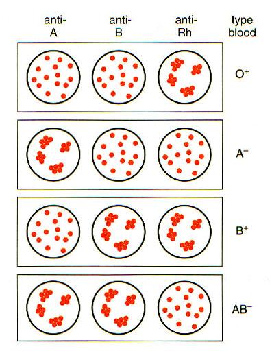 Blood typing kit Using the antibodies derived from plasma (antibodies are immobilized onto the blood typing kit) to determine the blood type If clumping occurs after a sample of blood is exposed to a