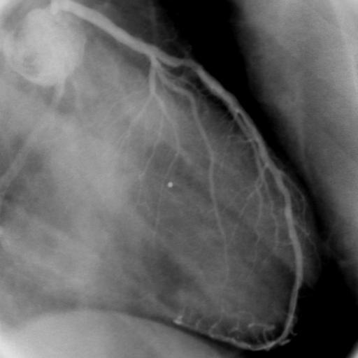 FFR in Diffusely Diseased Coronary Arteries N.F. 42-y-old man.