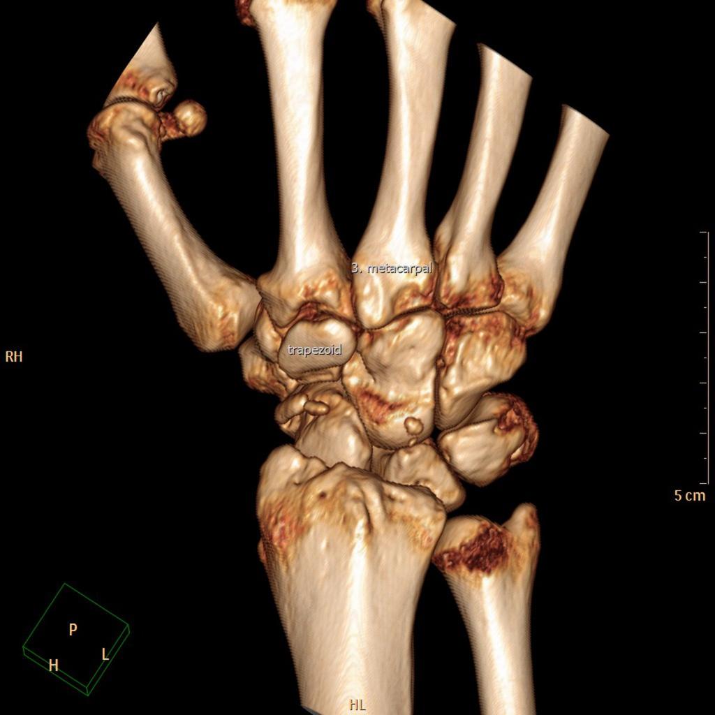Anatomical studies describe the presence of small ligaments between the third metacarpal and the trapezoid, but coalition in this position has to our knowledge not yet been described in the