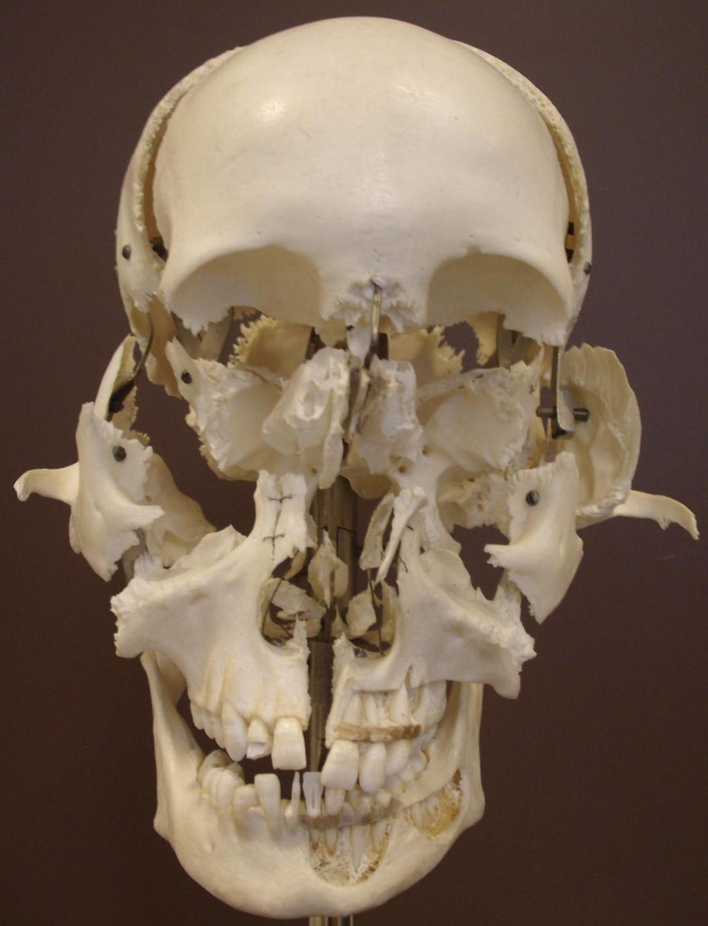 Beauchene Skull Lateral View Parietal Frontal Ethmoid