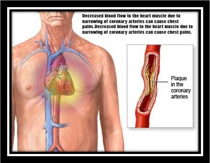 Arteriosclerosis http://1.bp.blogspot.com/_smg3fxietuk/s96rjr9ewa I/AAAAAAAACes/jTiOFGWrWZI/s1600/angina+aterosklerosis.