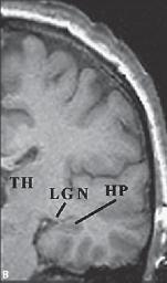 atrophy at level of temporal pole