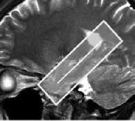 It is best imaged in two planes: parallel to the long axis of the hippocampus and