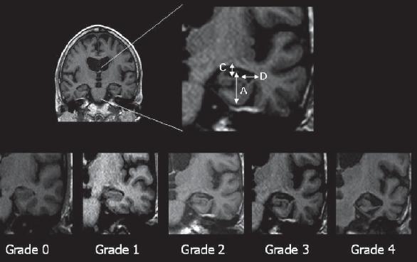 lateral ventricle (D) Rated in the coronal plane in T1w images on the slice that best