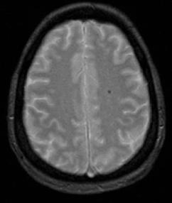Definitions cont d Cerebral Microbleeds (CMB s) Not visible on T1w, T2w, T2/FLAIR or CT Small (2-5 mm, max 10 mm) area of signal void with associated blooming Blooming artifact Signal void on T2*GRE