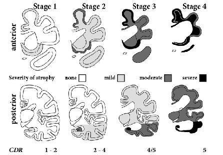 Imaging FTD Step 3 Assess the overall pattern of atrophy using the FTA scale from Kril and Halliday, 2011 Rate frontal, anterior temporal and posterior temporal for each hemisphere separately, which