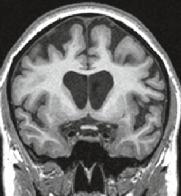penetrance by age 70 Mostly bv-ftd Other phenotypes ALS or FTD-ALS Symmetric atrophy of dorsolateral, medial and orbitofrontal lobes,