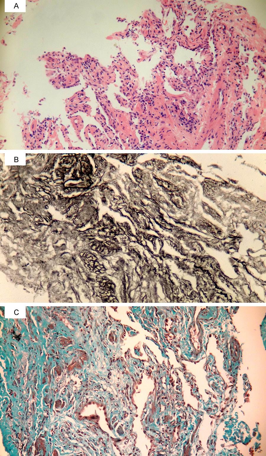 Figure 3. A. Association of fibrotic thickening and type 1 pneumocyte hyperplasia of the alveolar septa without inflammatory cells. No exudates were found in the alveolar lumen.