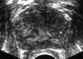 Conventional Gray Scale Features of Prostate