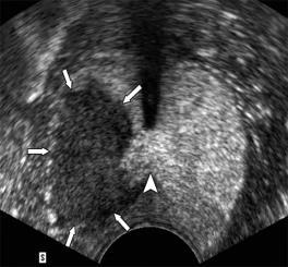 Urethra Neurovascular bundles Rectum Incomplete ablation - residual cancer Contrast US