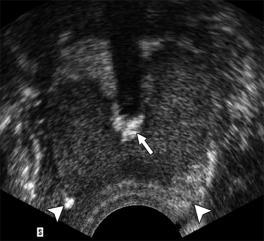 Contrast US Guidance for Ablation: Canine cold