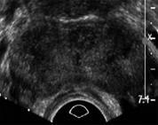 Conventional ultrasound detection is minimally