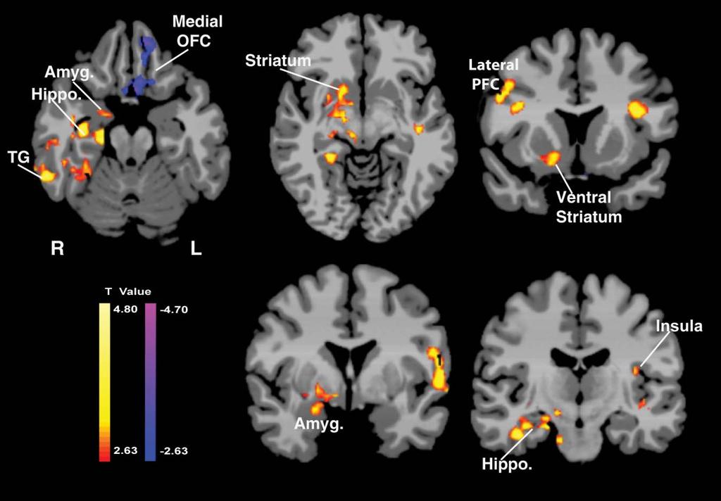 Corticostriatal-Limbic Activation During Emotional