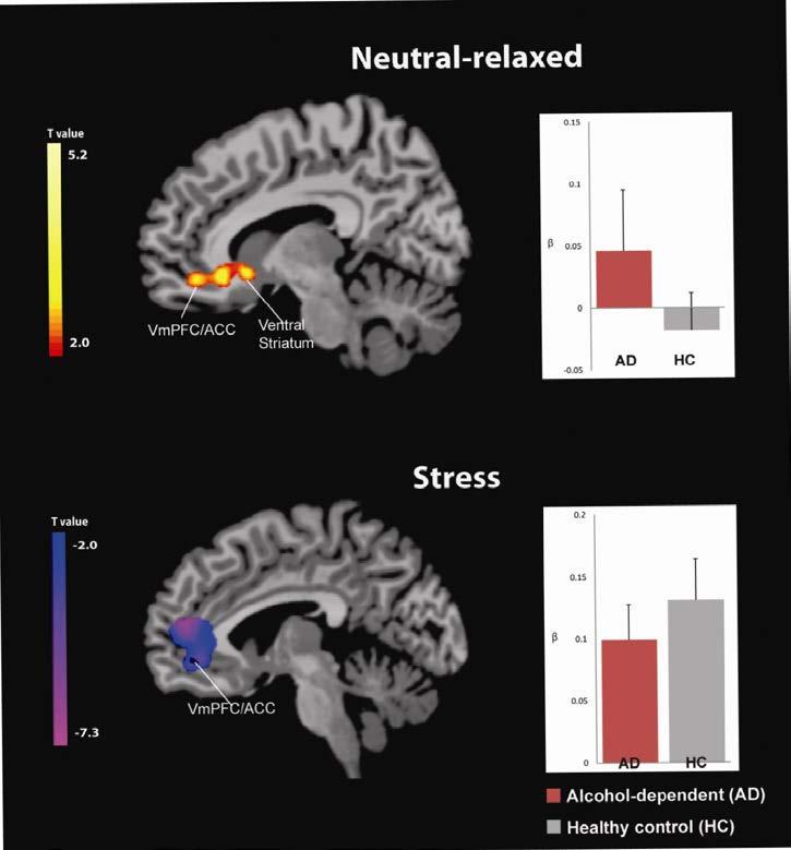 Disrupted Neural Response to Stress and Relaxed Scenarios in Recovering
