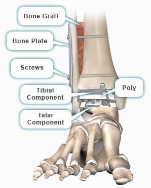 Advantages of Ankle Replacement Surgery:- Relieve pain and restore joint function in patients with end-stage degenerative joint disease resulting from osteoarthritis, traumatic arthritis or