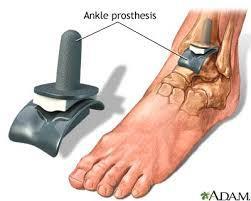How does the ankle replacement surgery work? Ankle replacement involves replacing the natural surfaces of the ankle joint which have degenerated with an artificial cover known as prosthesis.
