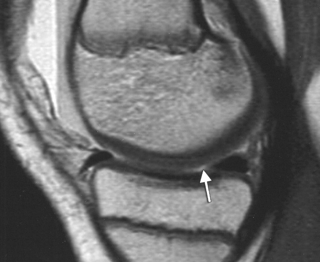 MRI of the Immature Knee The tibial plateau, femoral condyles, and patella were examined for evidence of fracture, bone bruising, and chondral injury.
