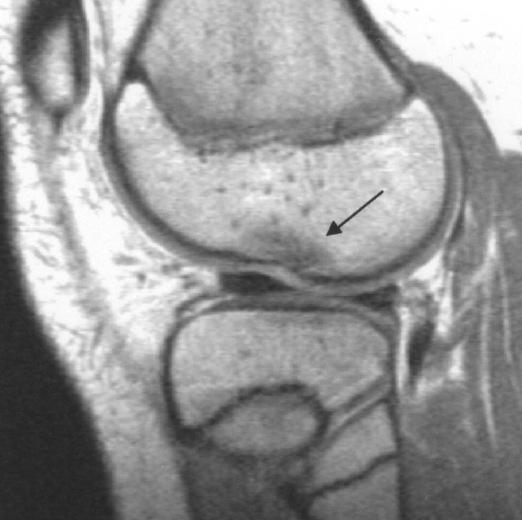 Oeppen et al. Fig. 4. Grade 3 lesion in 14-year-old girl with history of knee trauma and lateral joint pain. Patient also had osteochondral injury in medial patella.