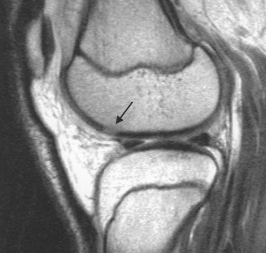 Large effusion and diffuse edema of marrow are also present., Sagittal proton density image shows area of cartilage discontinuity (arrow), anterior to anterior horn of lateral meniscus.