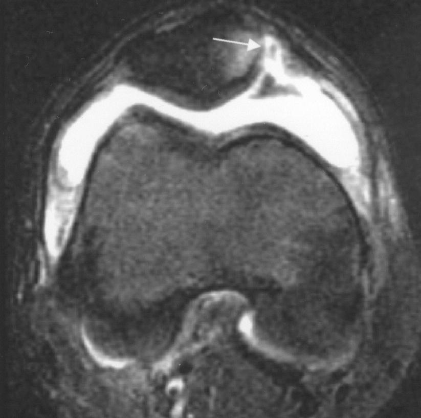 MRI of the Immature Knee Fig. 6. Grade 5 lesion in 14-year-old boy with history of lateral patellar dislocation after fall.