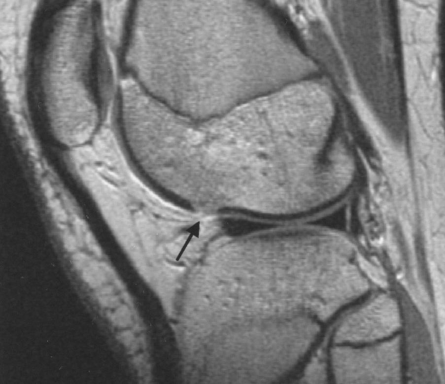 Chondral injuries were seen at arthroscopy in two of the five, and the cartilage was intact in the remaining three. On MRIs, only these two of the five patients had cartilaginous injuries.