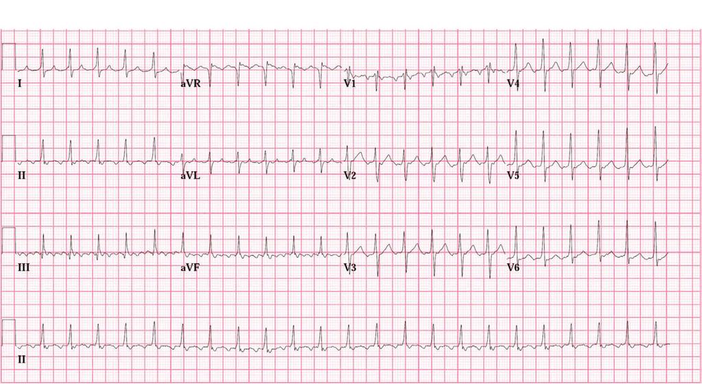 ECG & EP CASES Figure 1. Tachycardia electrocardiogram.