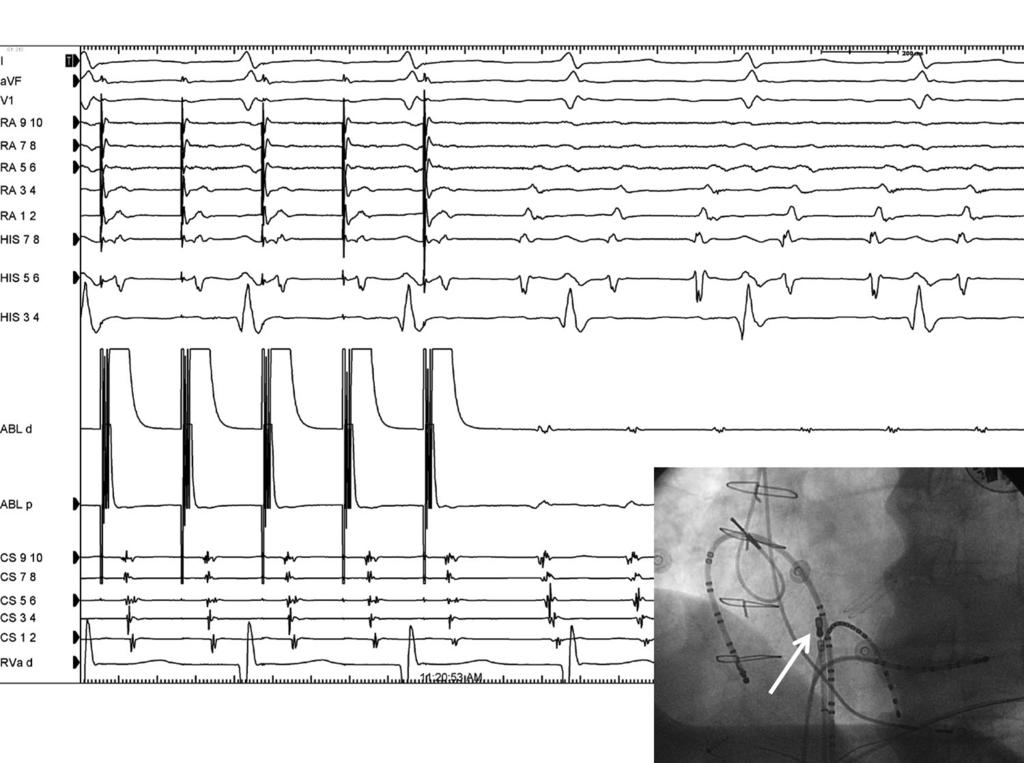 ECG & EP CASES Figure 2. Entrainment mapping. Stimulation was delivered at the septal side using an ablation catheter (ABLd, white arrow in the fluoroscopy image).