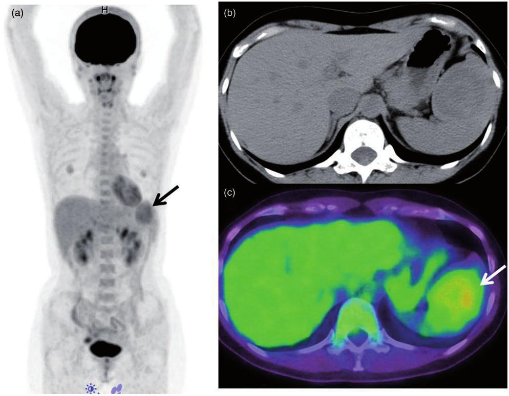 2 Acta Radiologica Open 5(8) CT was performed to determine if the mass was a hemangioma, hamartoma, or a malignant lymphoma of the spleen, as initially suspected.