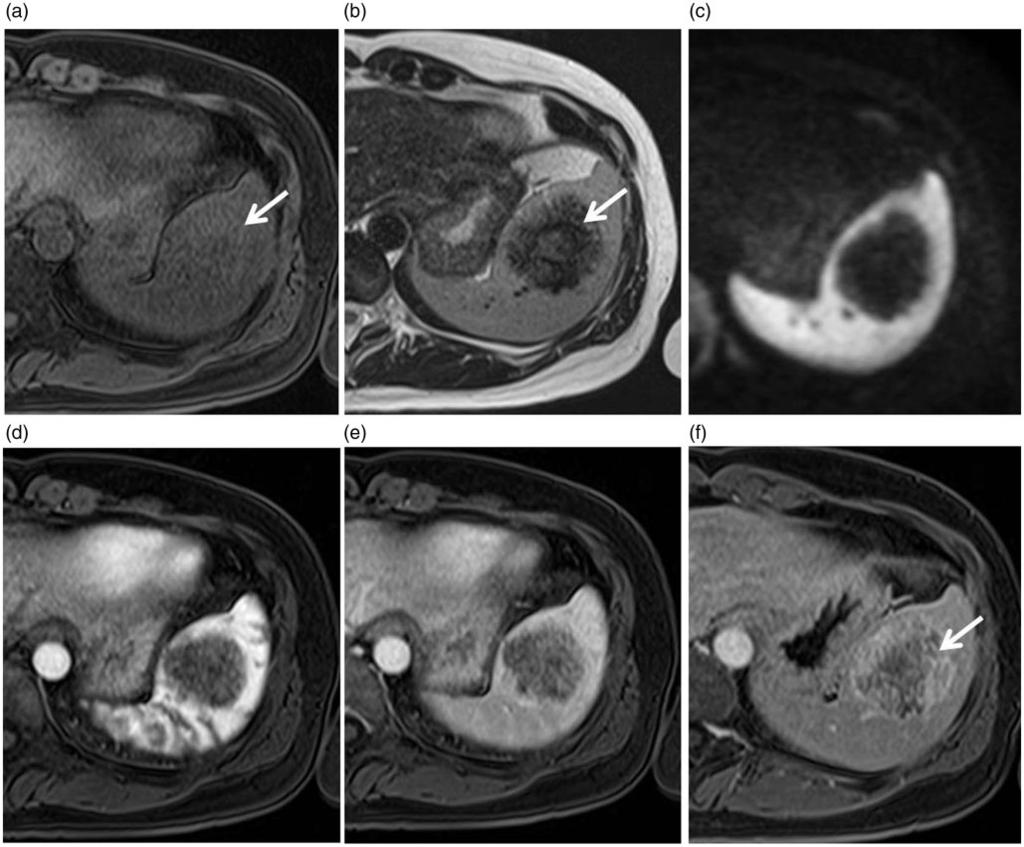 4 Acta Radiologica Open 5(8) Fig. 3. At 8-month follow-up.