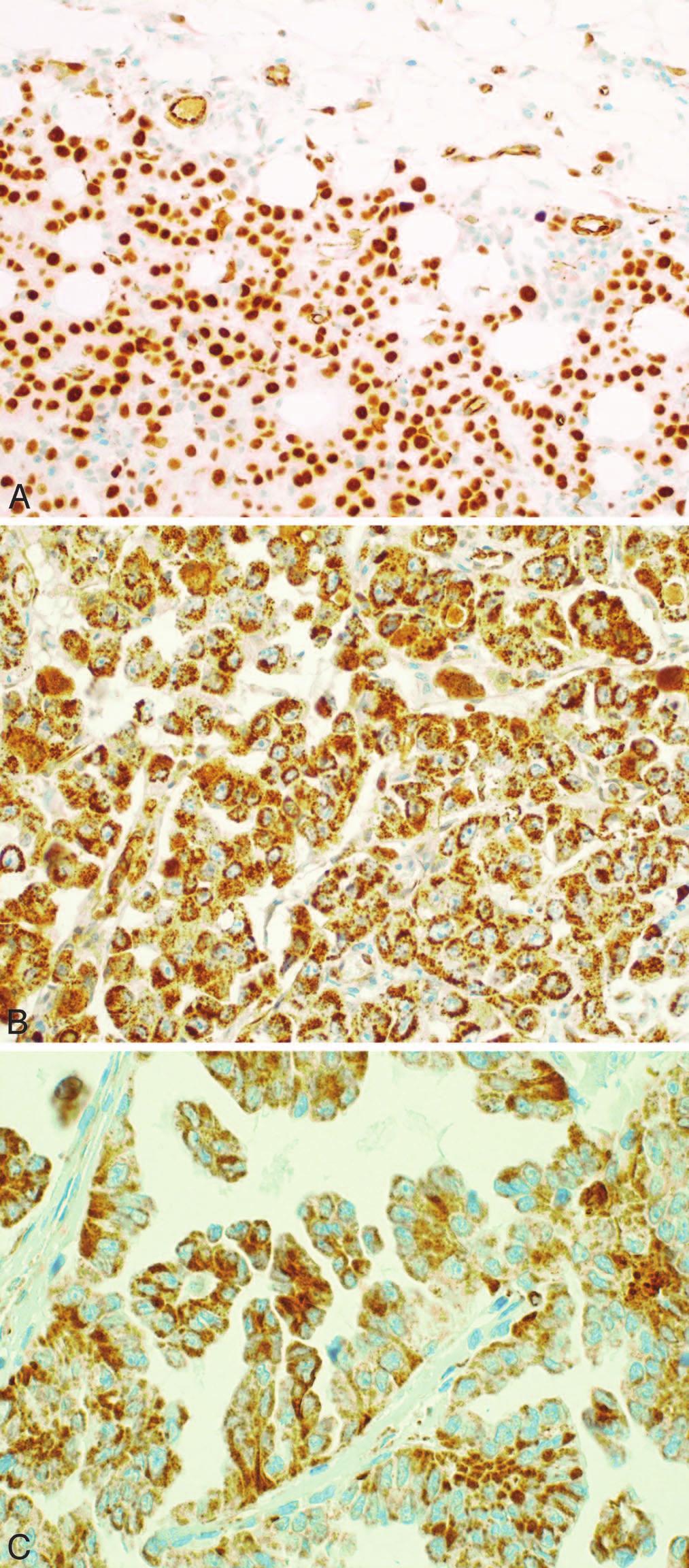 Figure 10. A through C, Wilms tumor-1 (WT1) staining. A, Strong nuclear staining in malignant mesothelioma invading fat. Note that endothelial cells show cytoplasmic staining only.