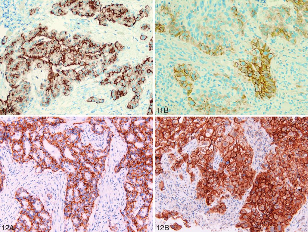 Figure 11. A and B, Podoplanin (D2-40) staining. A, Strong membranous staining in malignant mesothelioma. B, Focal staining in squamous cell carcinoma (original magnifications 3200 [A] and 3400 [B]).