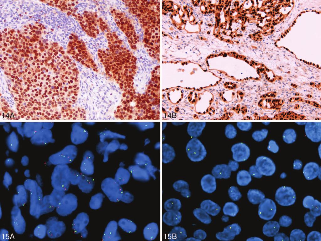 Figure 14. PAX8 shows strong nuclear staining in metastatic clear cell carcinoma from kidney (A) and in benign mesothelial proliferation from a hernia sac (B) (original magnification 3200 [A and B]).