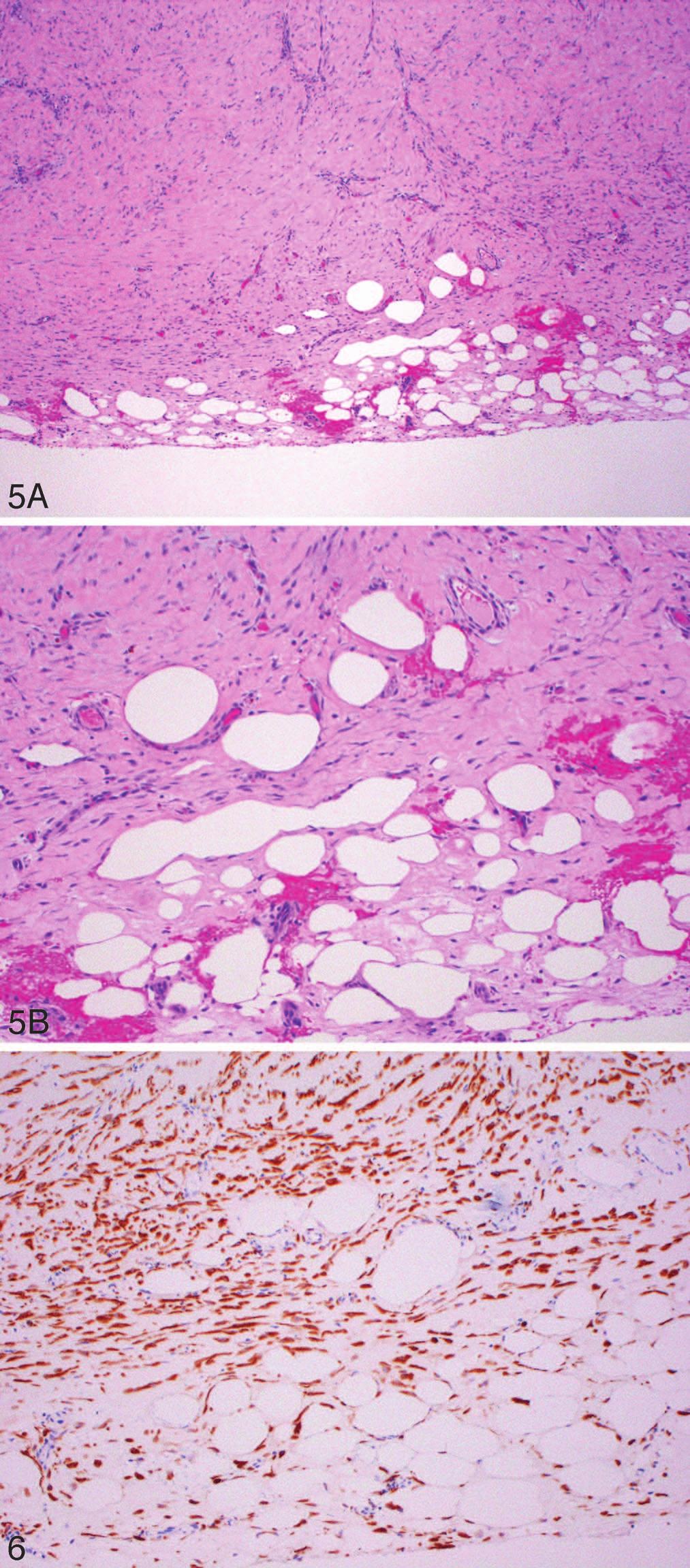 Figure 5. A and B, Fake fat in a pleural biopsy from a patient with effusion and fibrosis (hematoxylin-eosin, original magnifications 340 [A] and 3100 [B]). Figure 6.