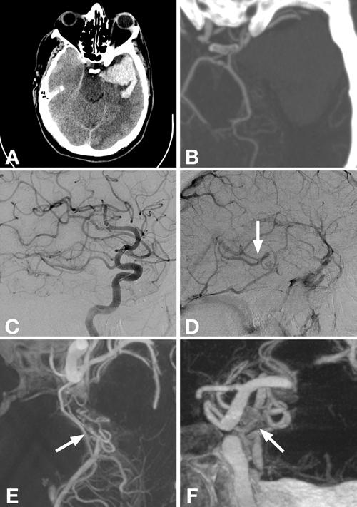 J. P. Rahal and A. M. Malek but give no recommendations as to the imaging modality of choice. Diagnostic cerebral angiography was found by Zhu et al.